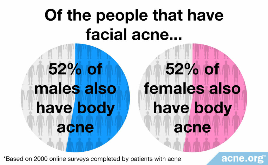 52% of males with facial acne and 52% of females with facial acne also have body acne