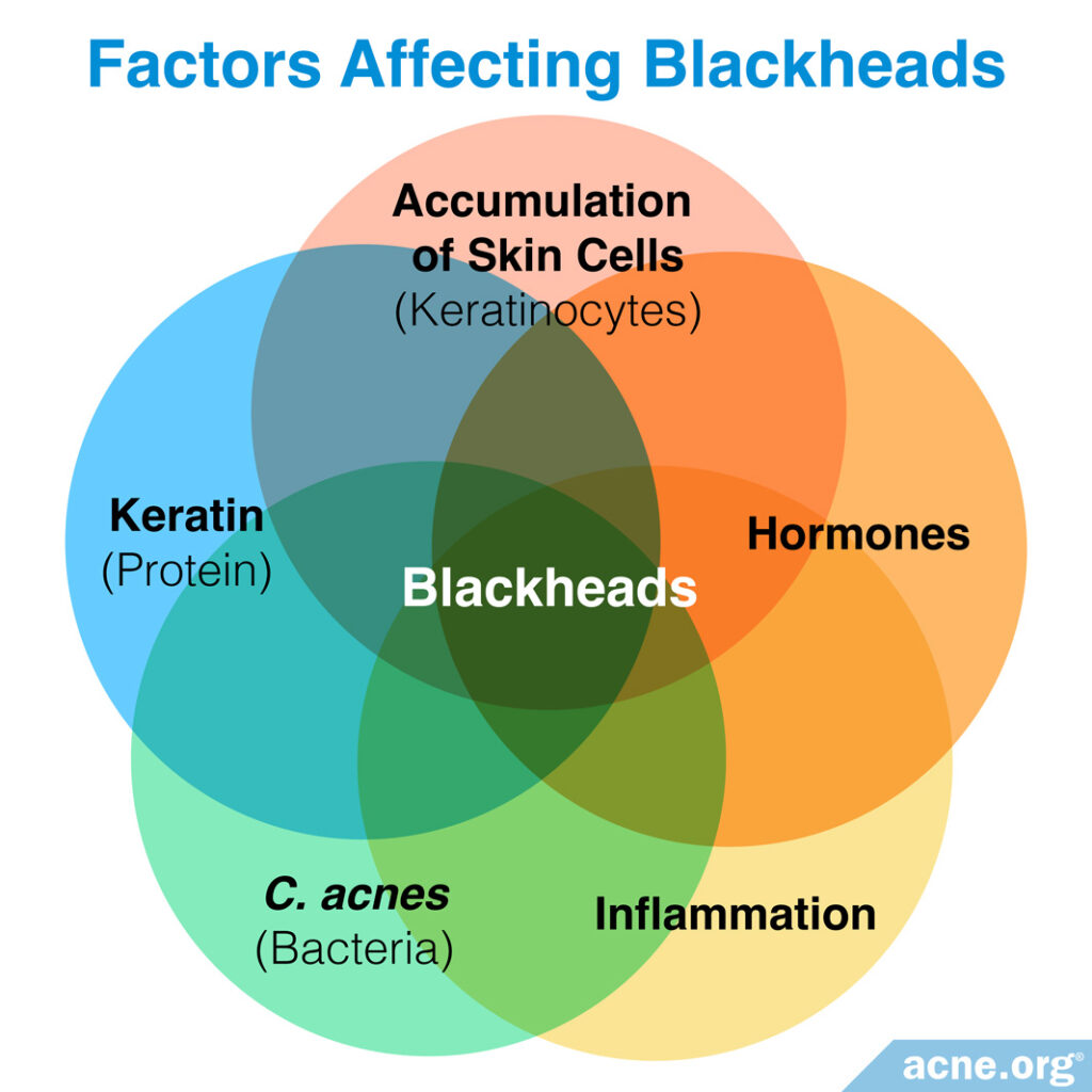 Factors Affecting Blackheads