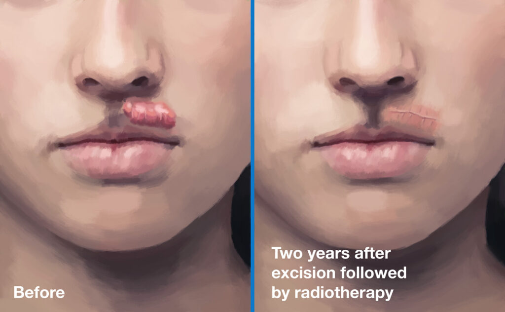 Excision-Before-After