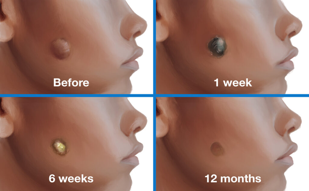Intralesional Cryotherapy Before and After