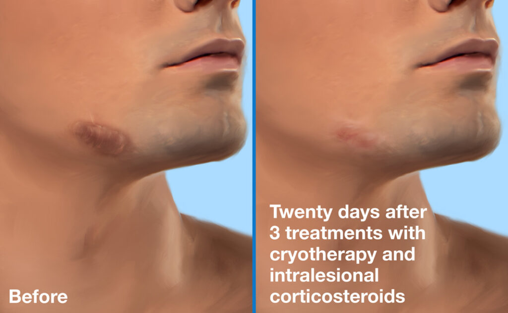 Cryotherapy-with-Intralesional-Corticosteroids-Before-and-After