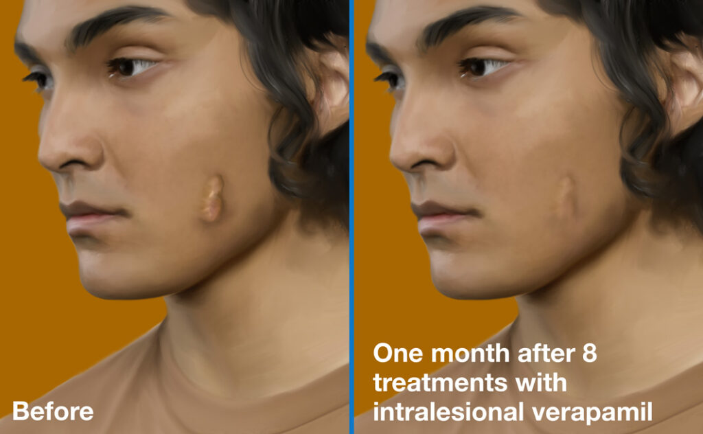 Intralesional-Verapamil-Before-and-After