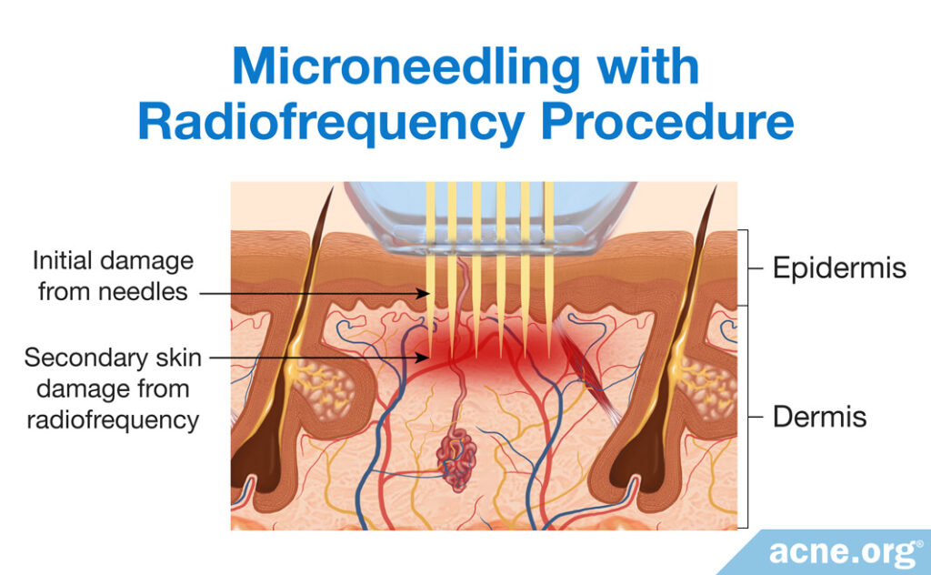 Microneedling-with-Radiofrequency-Procedure-1