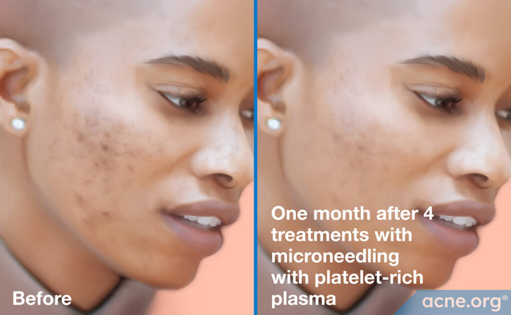 Microneedling-with-Platelet-rich-Plasma-Before-and-After-1