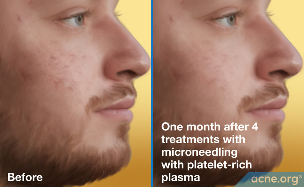 Microneedling-with-Platelet-rich-Plasma-Before-and-After-2