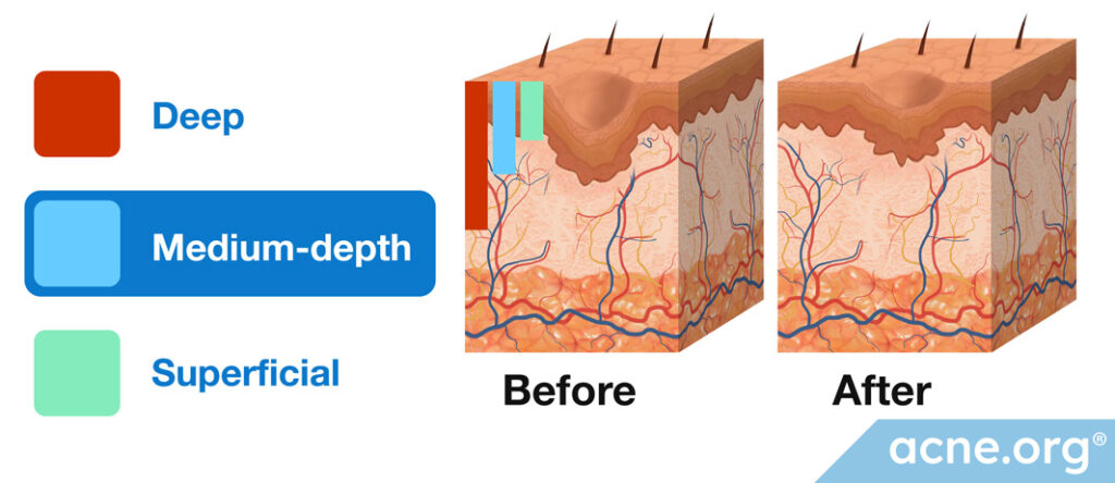 Chemical-Peel-Chart-(Medium)