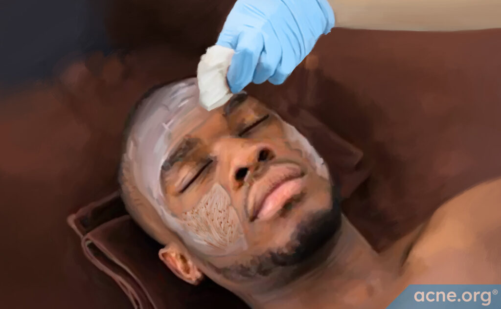 Chemical-Peel-Procedure-(Medium)