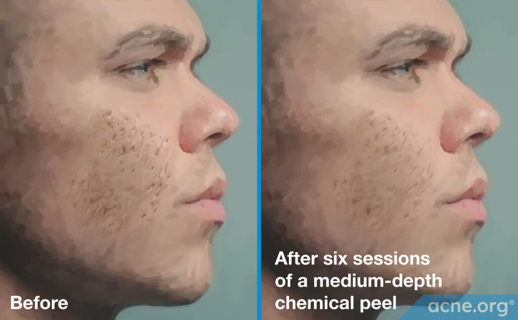 Medium-Peel-Before-and-After