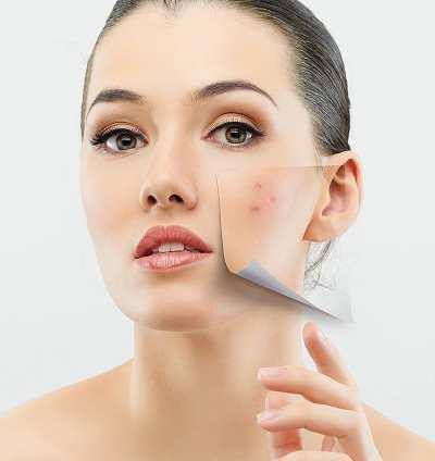 Profile picture of Natural Remedies for Acne