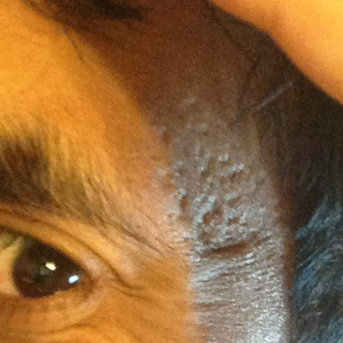 acne Scarred Temples