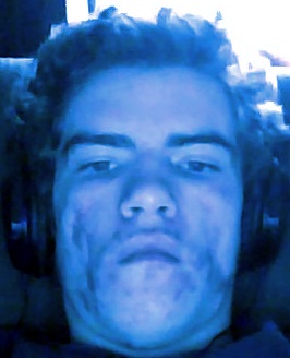 theteenwithacne